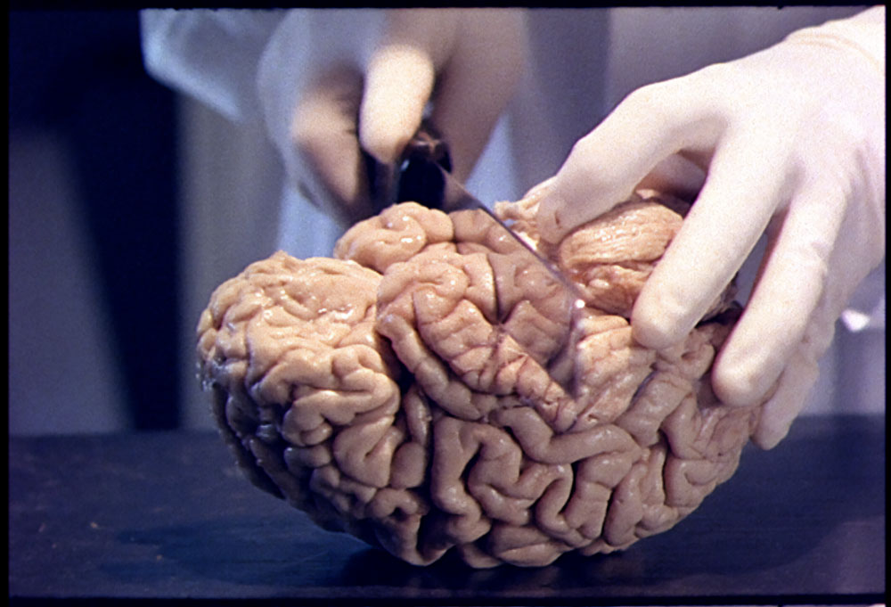 Gloved hands hold a scalpel to a human brain during a dissection.
